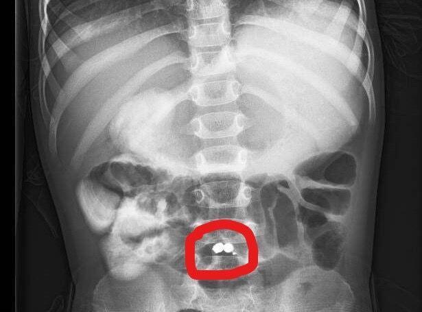 תמונת רנטגן של המגנטים במעי